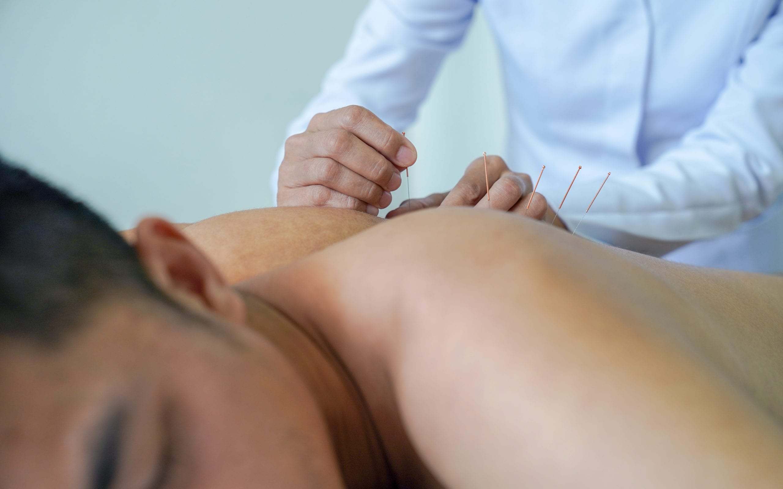 Dry Needling- physical therapy 