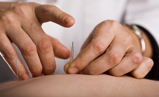 Dry needling with physical therapist